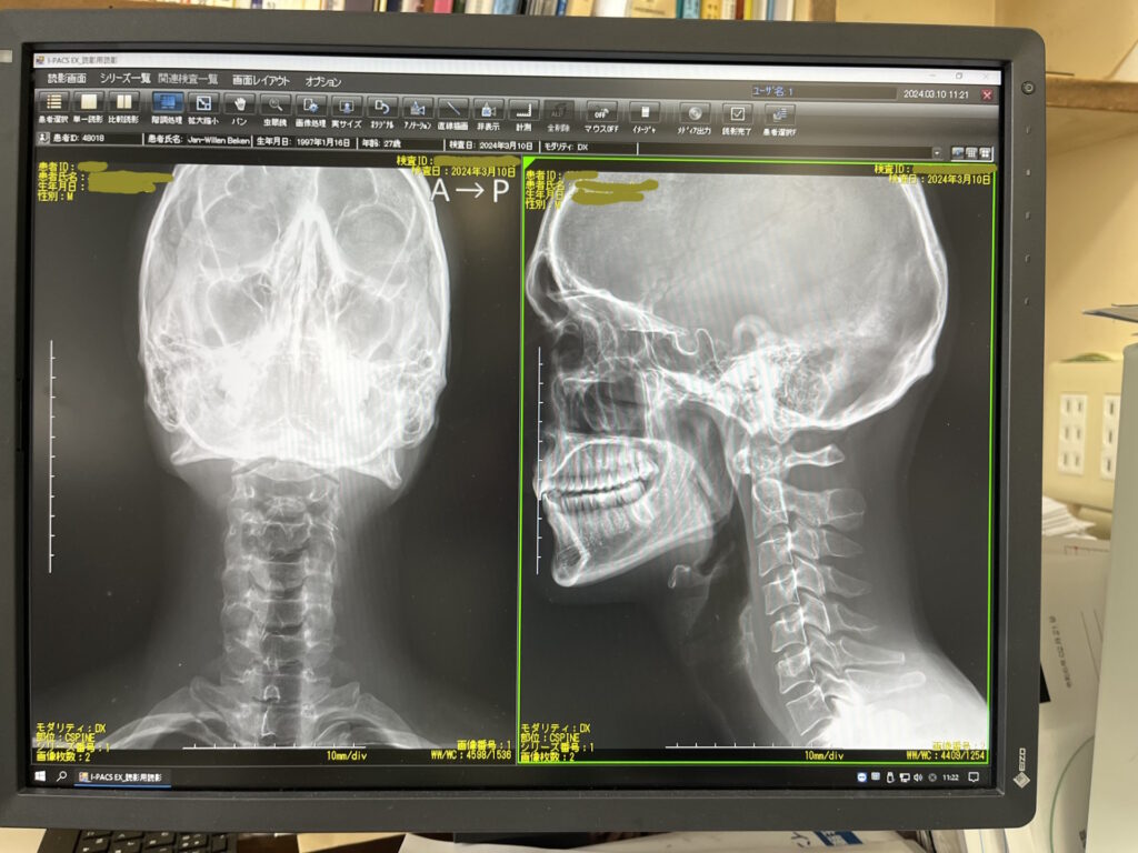 X-ray ski accident